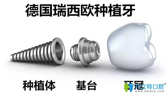 詳解德國進(jìn)口種植牙品牌:瑞西歐ht種植體的優(yōu)勢和價格