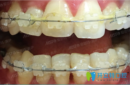 在愛思特口腔戴陶瓷托槽矯正牙齒術(shù)中照