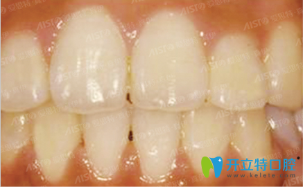 在重慶愛思特口腔做牙齒矯正后的效果圖