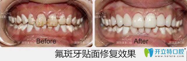 美萊口腔氟斑牙貼面修復(fù)案例