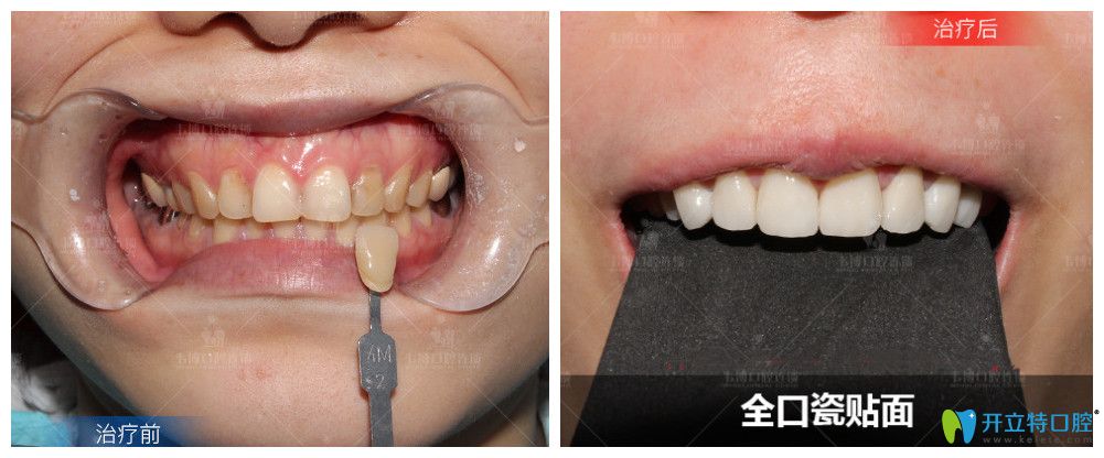 這里有深圳福田下沙韋博口腔瓷貼面美齒效果對比圖及價格