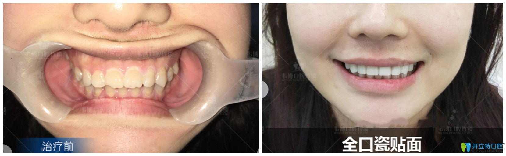 牙齒發(fā)黃，還缺損的小姐姐用瓷貼面來(lái)“武裝”牙齒