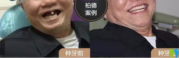 林伯在柏德口腔做的種植牙的前后對(duì)比圖
