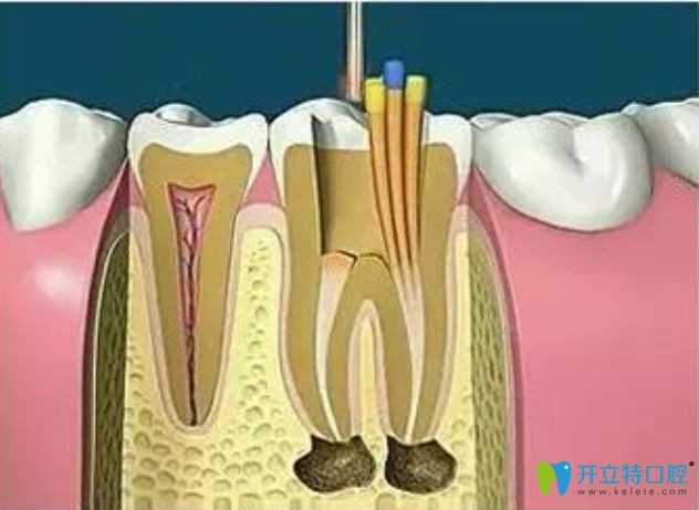 對(duì)根管進(jìn)行填充封閉整個(gè)根管系統(tǒng)
