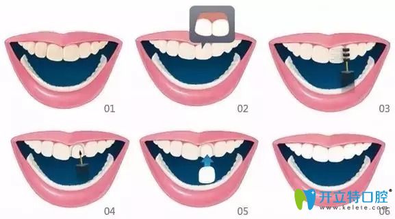 備受追捧的牙齒貼面材料選全瓷、硬質(zhì)和樹脂貼面哪個好