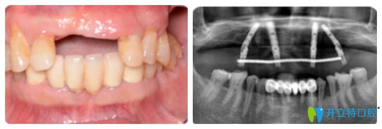 王迪院長為王先生做的連橋牙冠