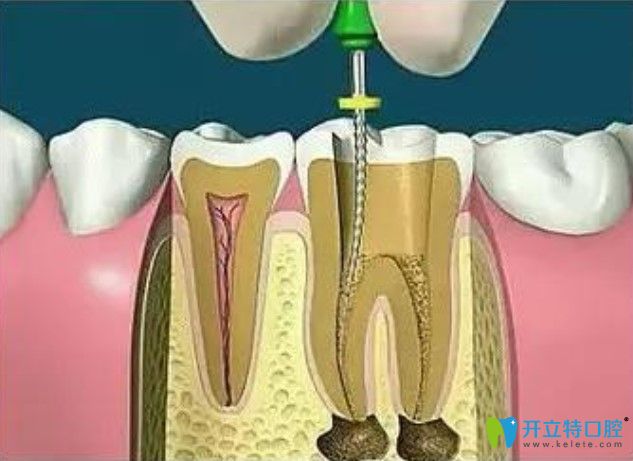 去除根管壁上的感染物