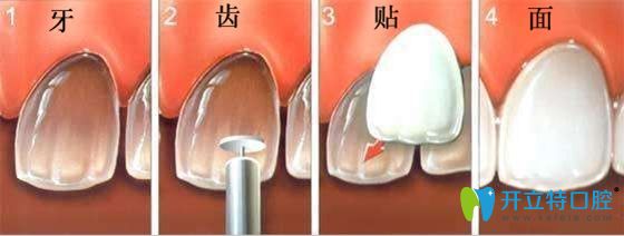 還在糾結(jié)美加牙貼面和義獲嘉瓷貼面選哪個(gè)好嗎?答案來了!
