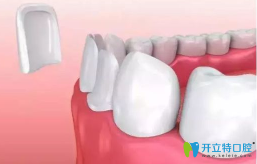 牙齒貼面有后遺癥？千萬別做樹脂牙齒貼面的真相
