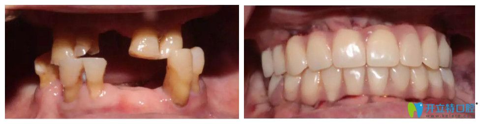 周阿姨在常州北極星口腔做的種植牙前后對比圖