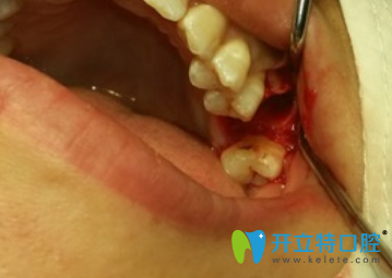 拔爛牙根過程及圖片了解一下疼嗎？關(guān)心多少錢可能會(huì)…
