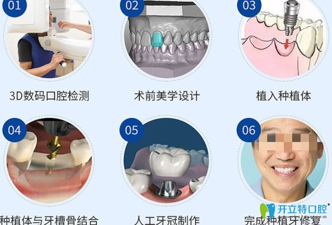 正夫口腔種植牙過程