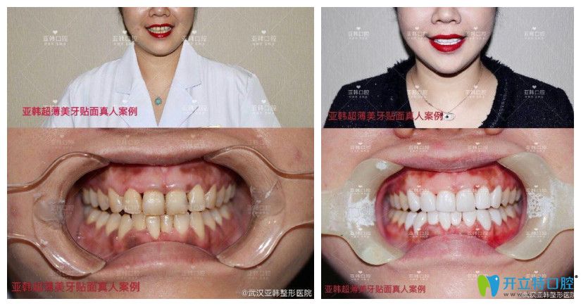 亞韓口腔黃牙做了超薄牙貼面修復(fù)案例對(duì)比圖
