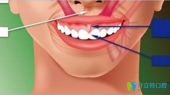 露齦笑現(xiàn)象展示圖