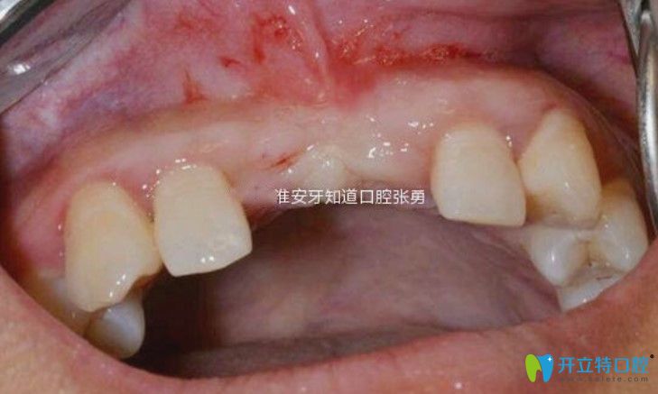 淮安哪里做種植牙好？顧客反饋淮安牙知道張勇種牙水平高