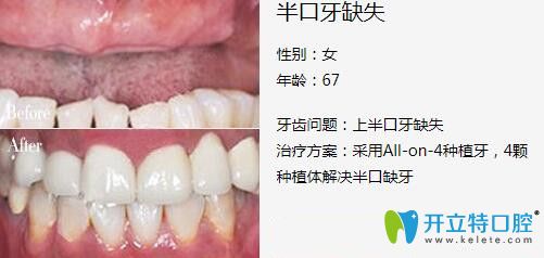 深圳弘和口腔半口種植牙案例