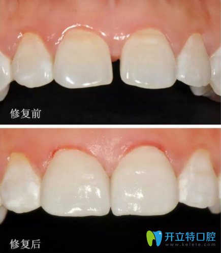 牙齒超薄貼面怎么樣？多少錢(qián)一顆？也許這個(gè)是你更關(guān)心的