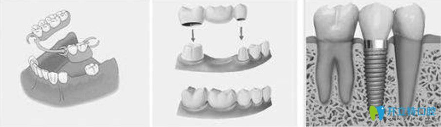 孔紅梅醫(yī)生告訴你種植牙、固定假牙和活動義齒相比有什么區(qū)別