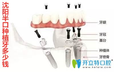 沈陽(yáng)半口種植牙多少錢