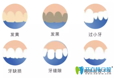 牙齒超薄貼面適應(yīng)癥