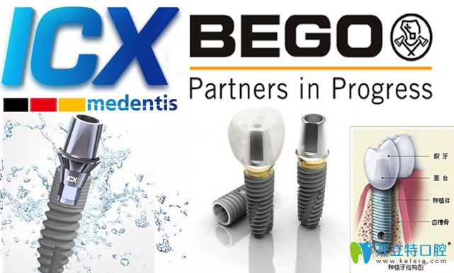 聽說德國種植牙系統(tǒng)還不錯,那德國icx和德國bego哪個更好呢?