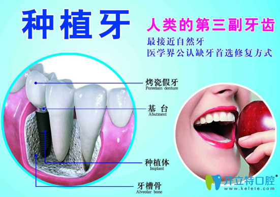 種牙需要時(shí)間長?那是沒了解微創(chuàng)種植牙是什么,利弊分析