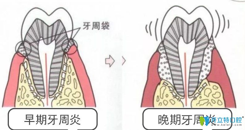 牙周病會導致牙槽骨被吸收