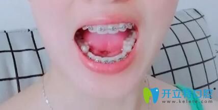 我在靖江艾齒嘉口腔戴牙套3個(gè)月