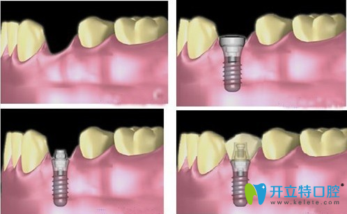 微創(chuàng)種植牙的過(guò)程