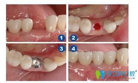 靖江艾齒嘉口腔陳濤醫(yī)生介紹種植牙注意事項(xiàng)