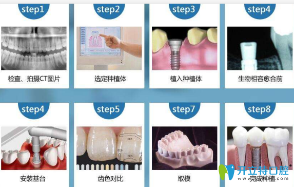 不翻瓣微創(chuàng)種植牙要不要縫線,需要多久？多少錢？補(bǔ)牙必看