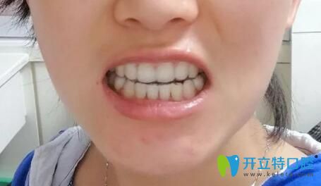 在靖江艾齒嘉口腔做牙齒矯正1年半