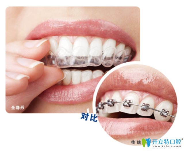 靖江艾齒嘉口腔朱彩寅醫(yī)生科普牙齒矯正注意事項(xiàng) 靖江艾齒嘉口腔朱彩寅醫(yī)生科普牙齒矯正注意事項(xiàng)