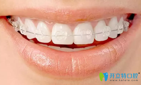 半隱形牙齒矯正明顯嗎？得從隱形和半隱形矯正的區(qū)別說(shuō)起