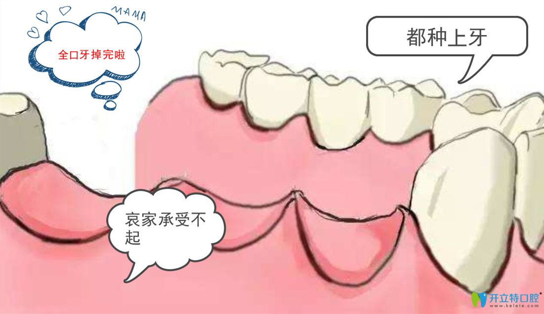 種植全口牙需要種幾顆？諾貝爾全口種植牙8顆多少錢(qián)?