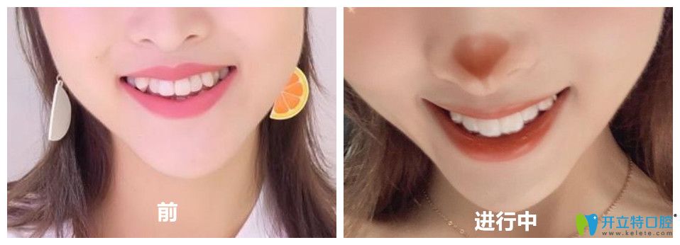 <i data-id=9e43c294-b365-4919-b6fa-eec2d7e0f6fe></i>口腔隱適美矯正案例