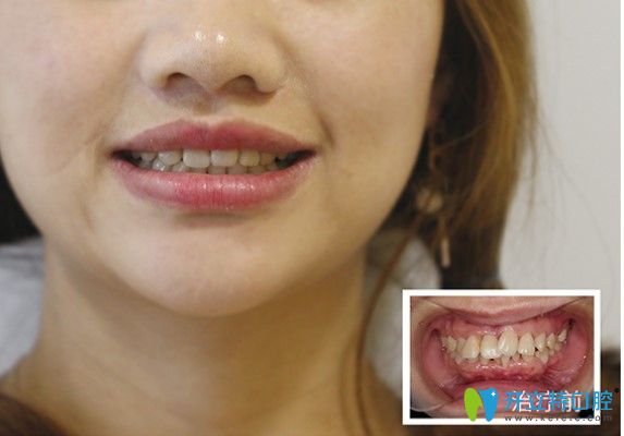 牙齒矯正有辣么厲害嗎？歪牙小姐姐通過正畸重獲整齊牙齒