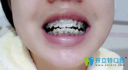 我在石家莊中諾口腔做牙齒矯正1年半 我在石家莊中諾口腔做牙齒矯正1年半