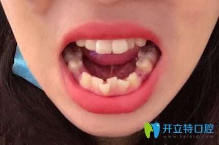 石家莊中諾口腔不止種植牙靠譜,我做的牙齒矯正效果也很贊