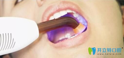 牙齒皓齒美白