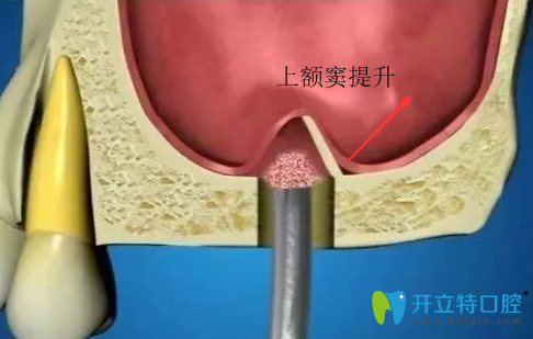 上頜竇提升種植牙