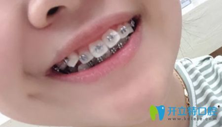 我戴金屬自鎖牙套矯正4個月效果圖
