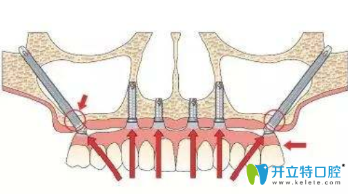 穿顴種植手術圖片