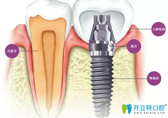 牙槽骨小于幾毫米不能種牙？怎么判斷牙槽骨薄,這篇就夠了