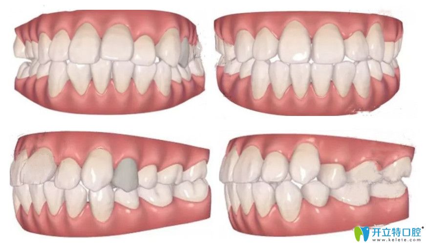 公開我的隱適美矯正齙牙記錄！我?guī)а捞?~12月變化圖明顯不