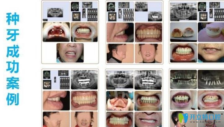 立得用種牙成功案例