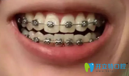 我虎牙外突側(cè)門牙扭轉(zhuǎn)，矯正兩年后的效果