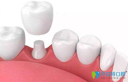 美容冠矯正牙齒的方法展示圖