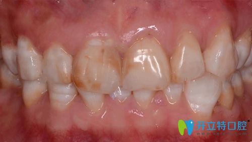 在牙齒貼面前的牙齒放大照