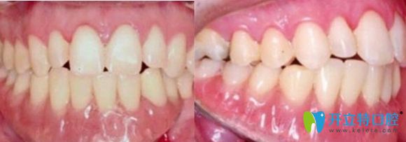 深圳佳美口腔半口牙種植術后效果圖